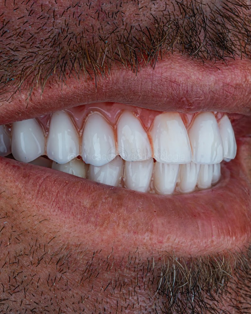 Implantes Dentários | Dentista | Clínica Coimbra Odontologia | Nova Iguaçu RJ