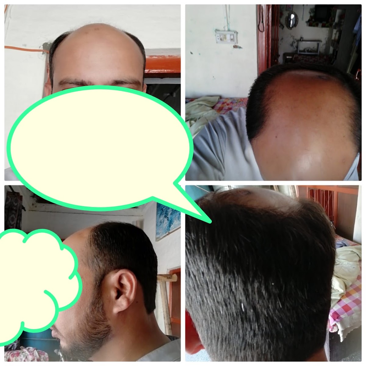 Glamorous PRP Hair Therapy Clinic Dubai - PRP Face & Hair 3