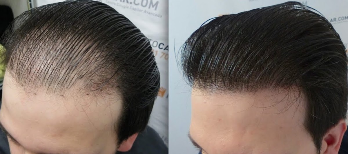 Glamorous PRP Hair Therapy Clinic Dubai - PRP Face & Hair 4