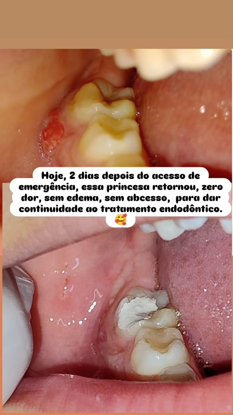 Odontopediatria Centro Duque de Caxias | Clínica Silveira Franzen, Extração de Siso, Aparelho Dental, Clareamento, Canal - foto 4