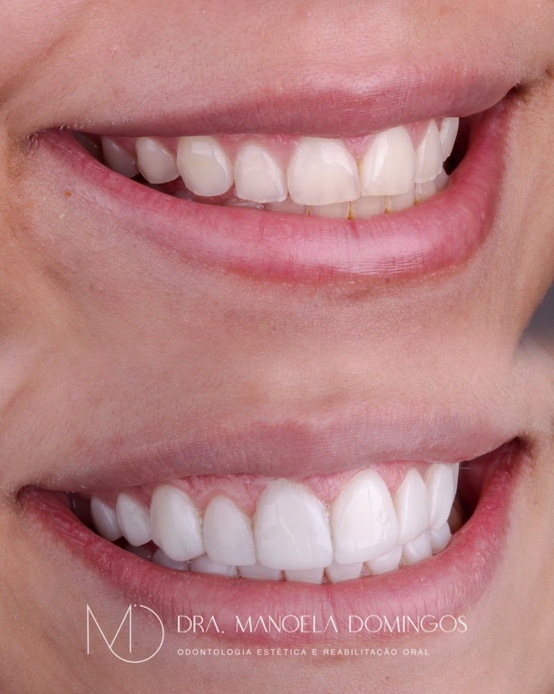 Dra Manoela Domingos - Lentes de Resina e Implantes Dentários
