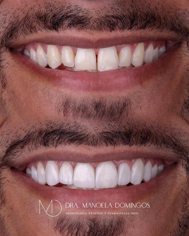 Dra Manoela Domingos - Lentes de Resina e Implantes Dentários - foto 4