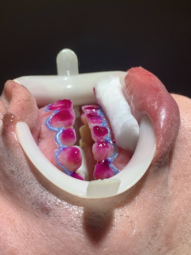 Dentista em Recife - Sedação com nitroso - Implante - Dente Siso - Lorena Pinheiro - foto 2