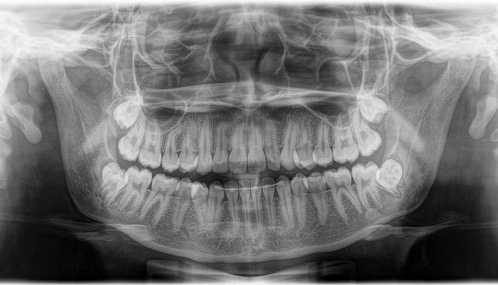 Dentista em Recife - Sedação com nitroso - Implante - Dente Siso - Lorena Pinheiro - foto 3