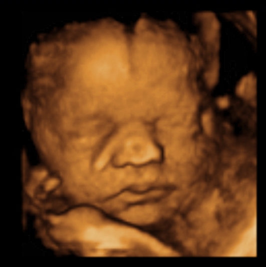 Sneak Peek Keepske Ultrasound, LLC