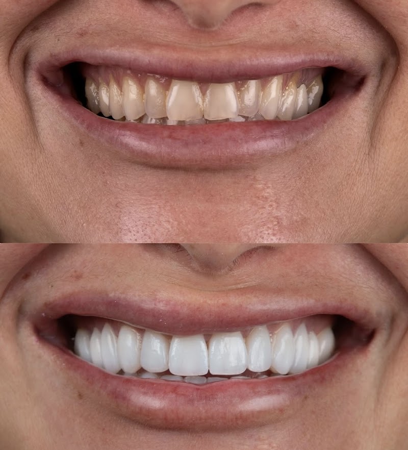Dra Natalia Liuzzi - Lentes de Contato Dental e Facetas de Porcelana - Dental Tourism - Dental Veneers - Dentist for Expats - foto 2