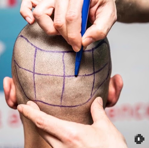 Adonis Med | Hair Transplant logo