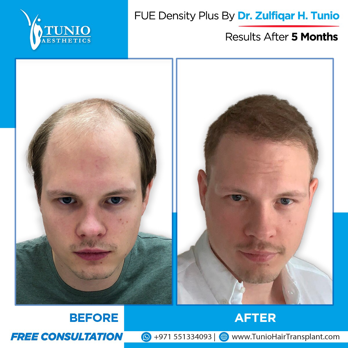 Tunio Aesthetics Hair Transplantation Clinic Dubai 4