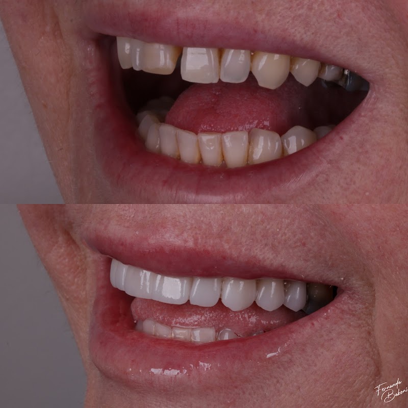 Dra. Fernanda Baboni | Harmonização Facial em Curitiba | Facetas de Resina - foto 4