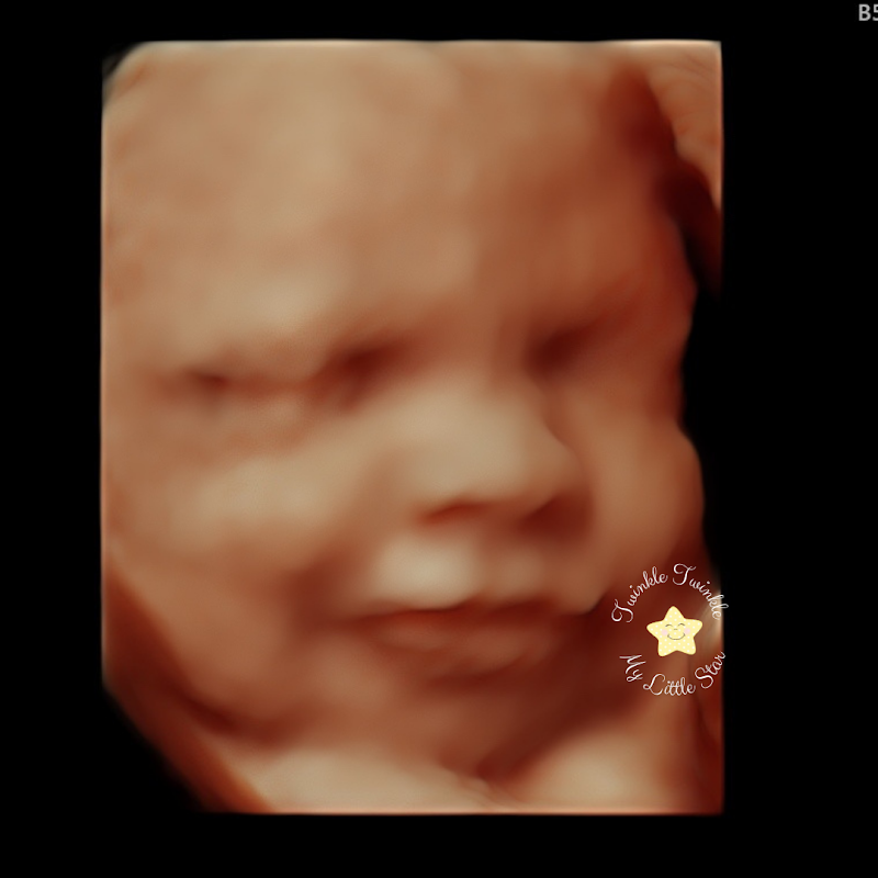 Twinkle Twinkle My Little Star Ultrasound
