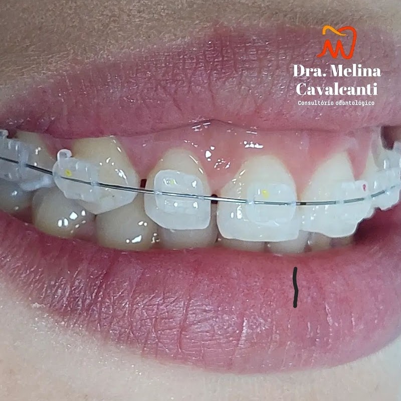 Dra. Melina Cavalcanti - Ortodontia / Alinhadores Invisíveis SouSmile e Harmonização Facial - foto 5