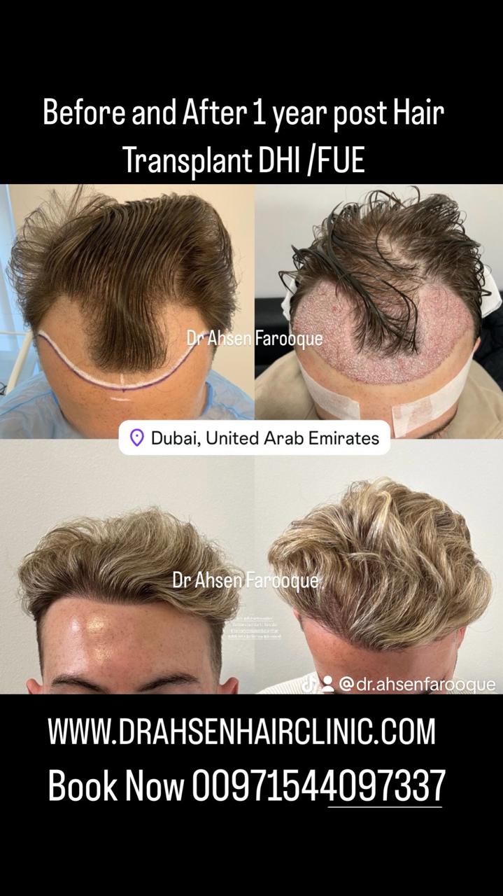 Dr Ahsen Farooque MD ABHRS USA Dhi Fue Fut Hair Transplant Surgeon Dubai 2