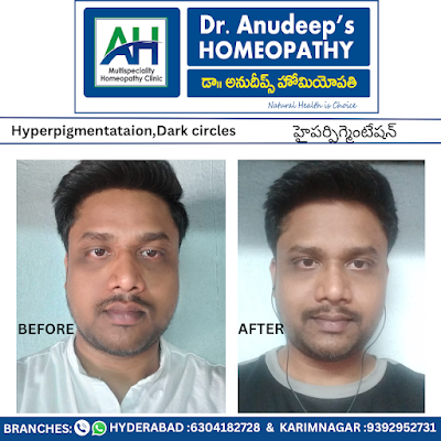 Dr.Anudeep's Homeopathy Hyderabad | A Multi-speciality Homeopathy Clinic | Best Homeopathy Doctor Hyderabad - Image 3