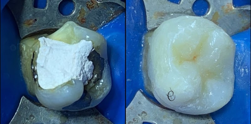 Hémylen Coimbra - Dentista - Endodontia - Canal - Biomimética - foto 2