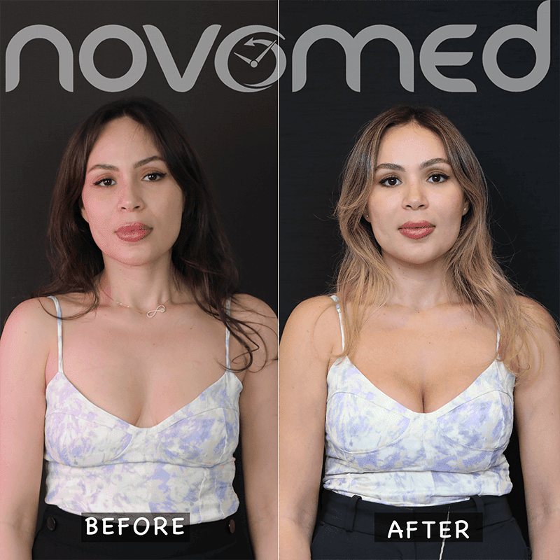 Novomed Plastic Surgeon Dubai Rhinoplasty BBL Liposuction Gynecomastia Tummy tuck Facelift Breast body lift Butt filler Botox 4