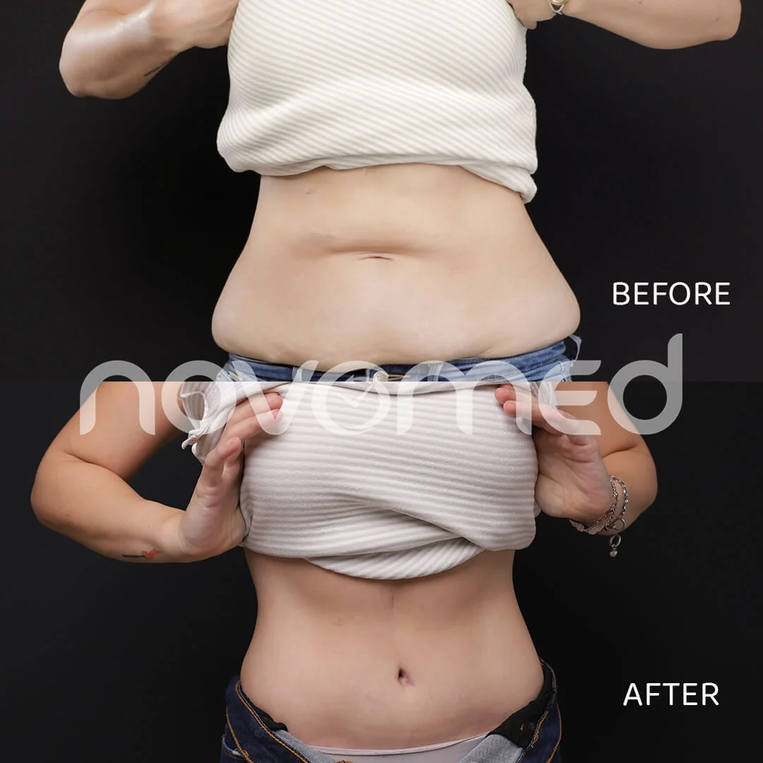 Novomed Plastic Surgeon Dubai Rhinoplasty BBL Liposuction Gynecomastia Tummy tuck Facelift Breast body lift Butt filler Botox