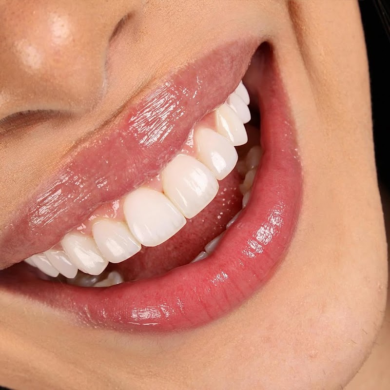 Avancce Clínica Odontológica Integrada Zona Sul - Facetas em resina em Recife - foto 2