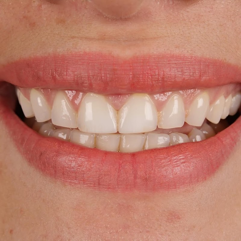 Avancce Clínica Odontológica Integrada Zona Sul - Facetas em resina em Recife - foto 4