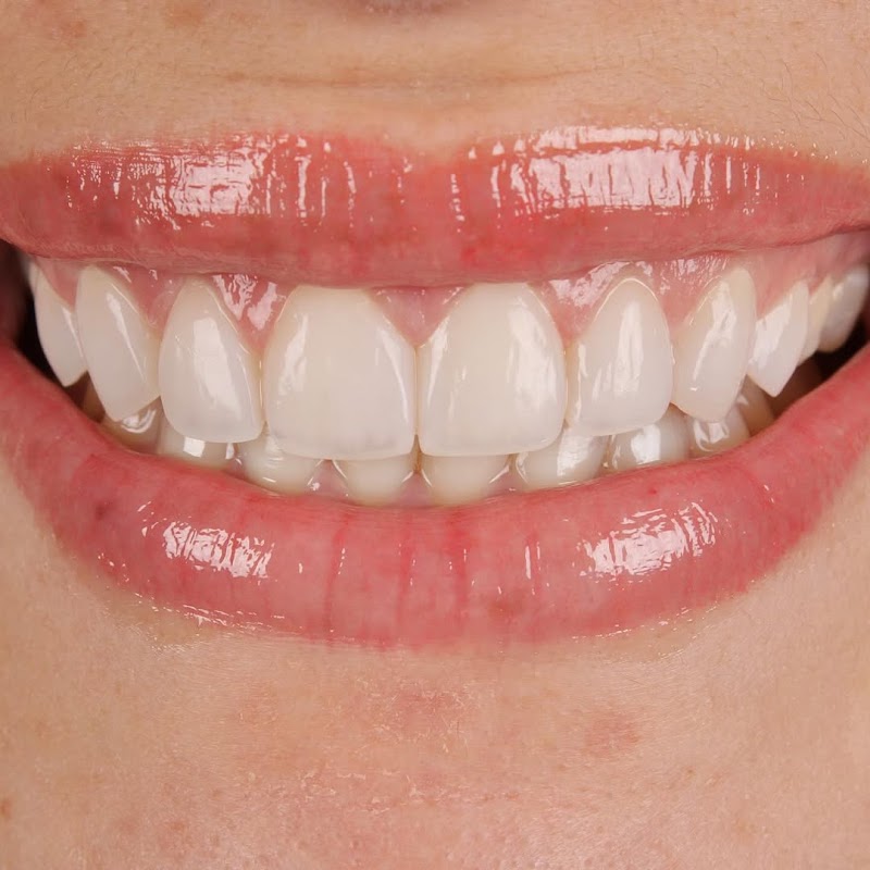 Avancce Clínica Odontológica Integrada Zona Sul - Facetas em resina em Recife - foto 3