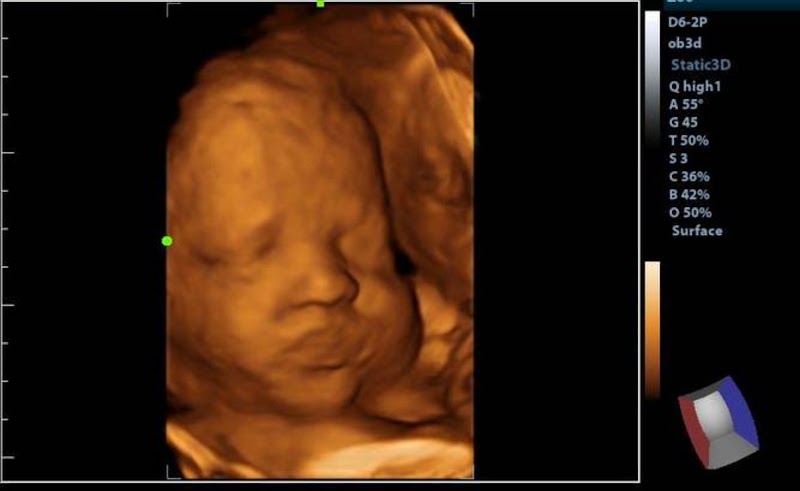 Tiny Treasures 3D/4D Ultrasound