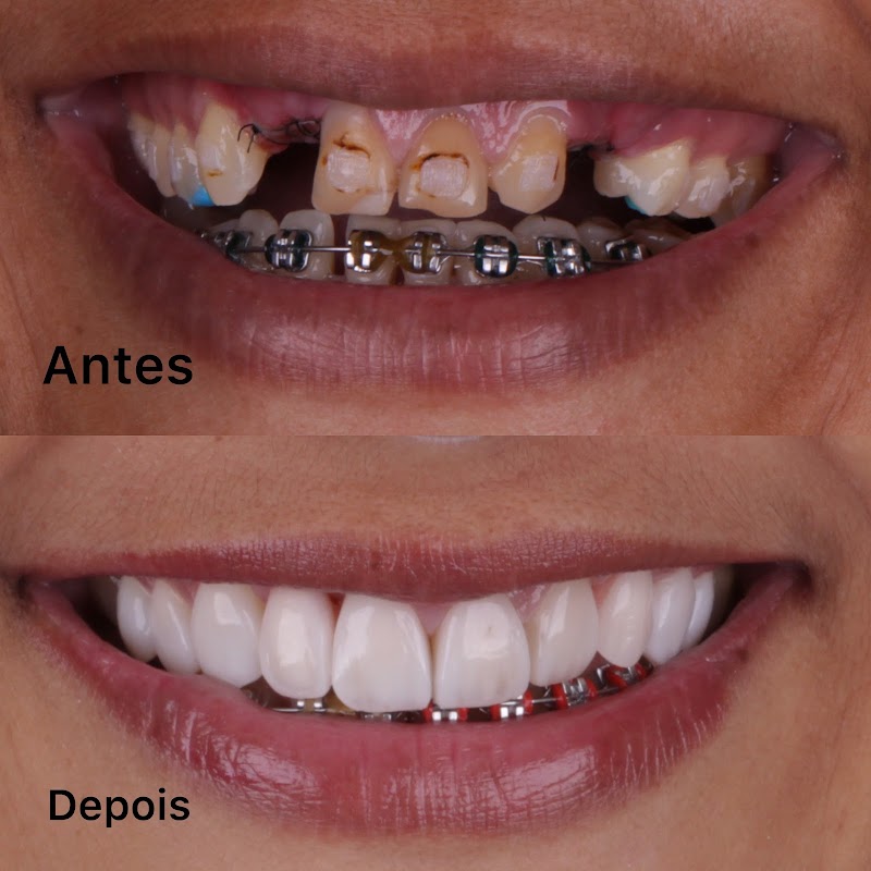 Dental Clean – Implantes Dentários, Facetas em Resina e Lentes de Contato Dental - foto 5