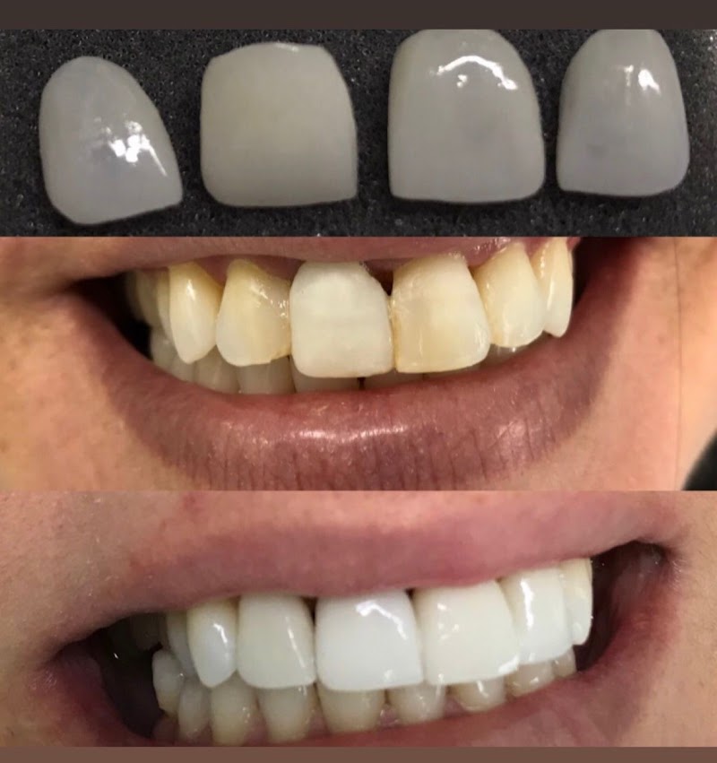 Implantelaser - foto 5