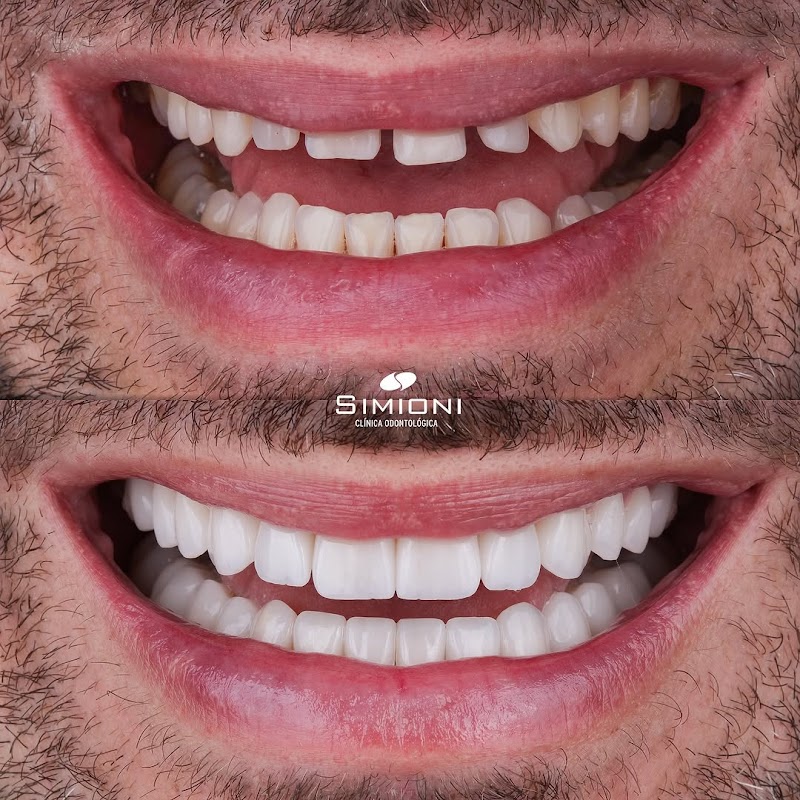 Simioni Odontologia - Implante e Lente de Contato Dental - foto 2