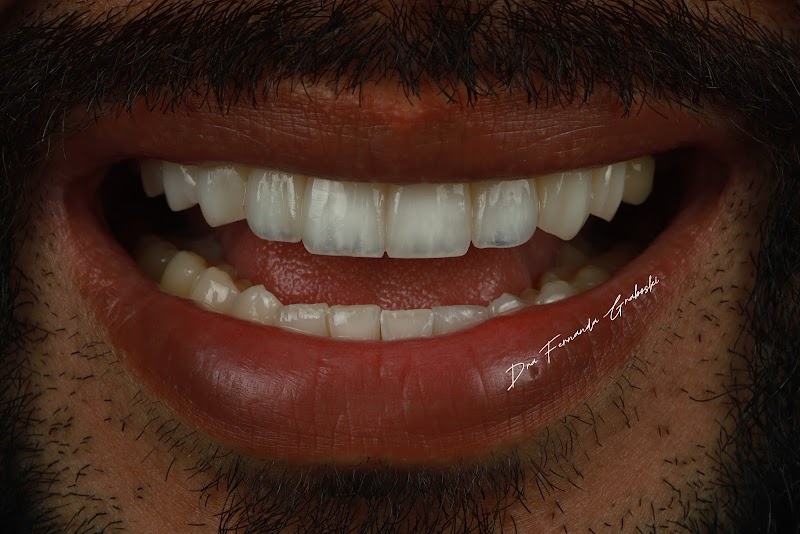 Dra. Fernanda Graboski | Facetas em Resina e Odontologia Biomimética - foto 2