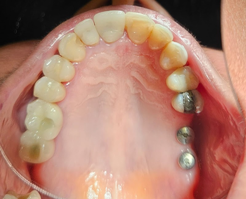 Implante Dentário em Uberlândia | Dr. Leandro Diniz | Extração De Siso | Cirurgião Dentista - foto 3