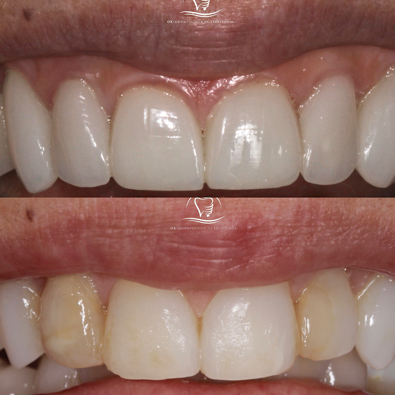 OX Odontologia de Excelência | Lente de Contato | Implante | invisalign | Prótese | Protocolo | Dentista Campo Grande - foto 2