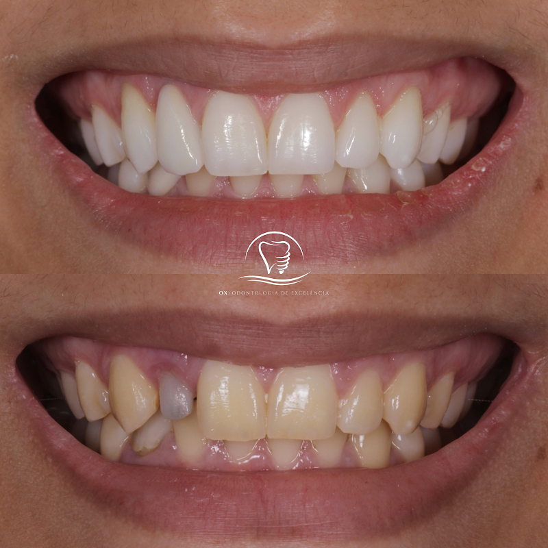 OX Odontologia de Excelência | Lente de Contato | Implante | invisalign | Prótese | Protocolo | Dentista Campo Grande