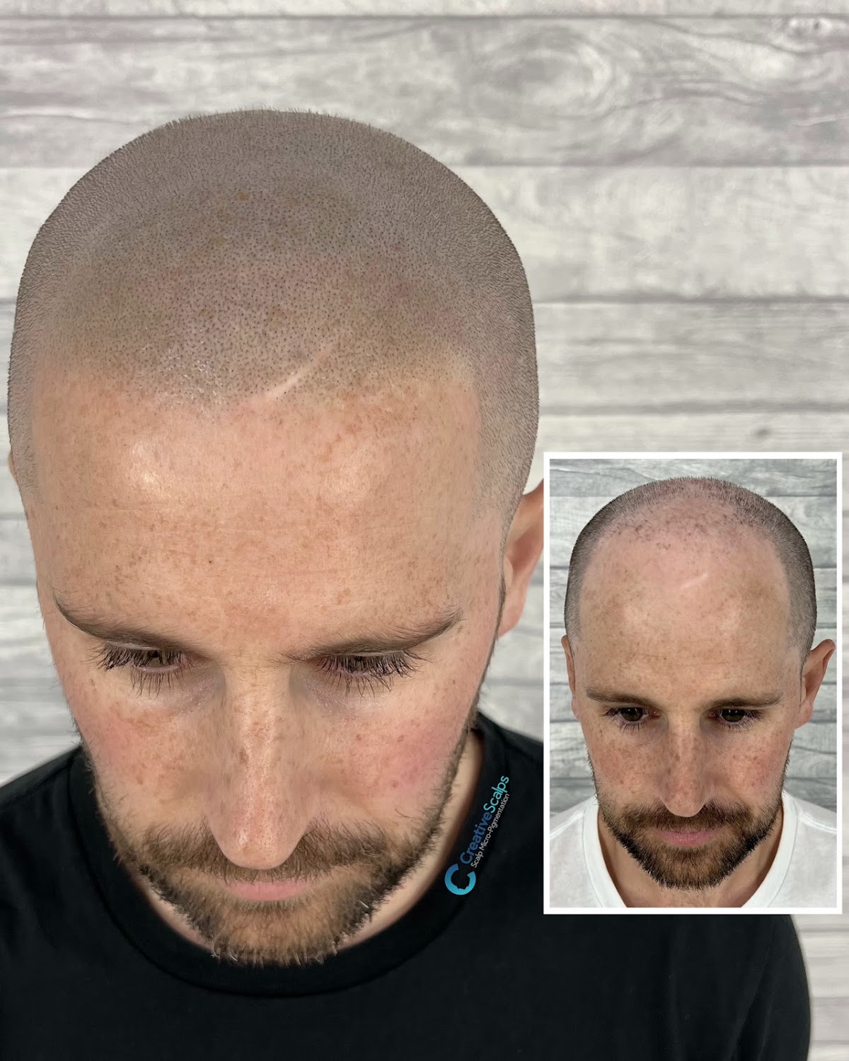 Creative Scalps Dubai - Scalp Micropigmentation 3