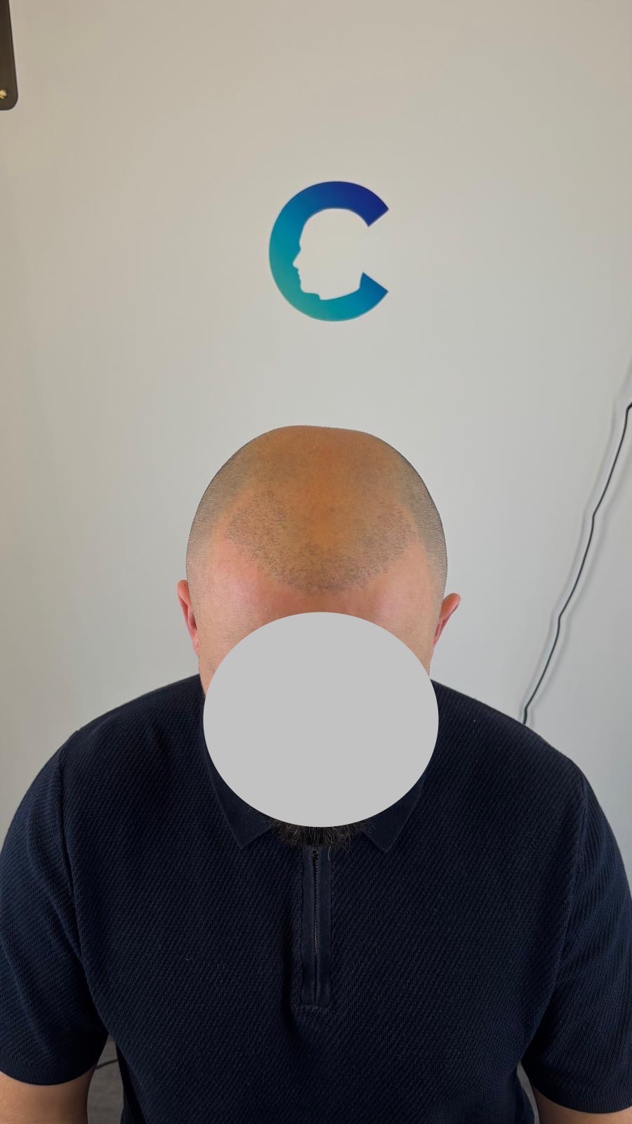 Creative Scalps Dubai - Scalp Micropigmentation 5