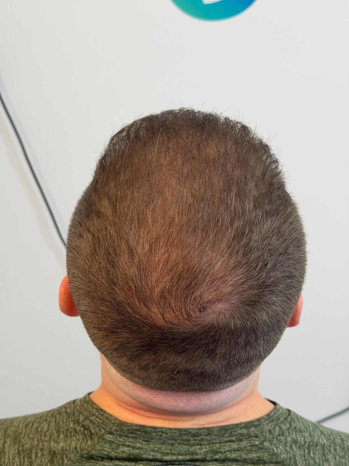 Creative Scalps Dubai - Scalp Micropigmentation 2