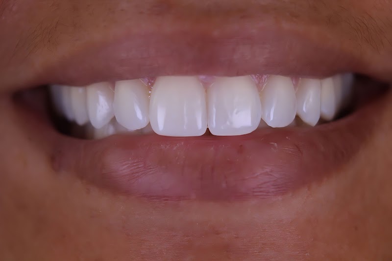 Dentista Rafaela Lopes - Lente de Contato Dental em Salvador - Lentes de Resina Valor facetas - foto 4