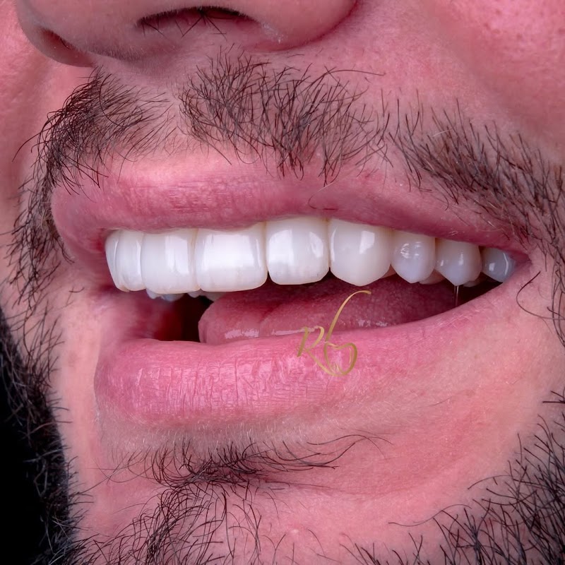 Dentista Rafaela Lopes - Lente de Contato Dental em Salvador - Lentes de Resina Valor facetas - foto 3