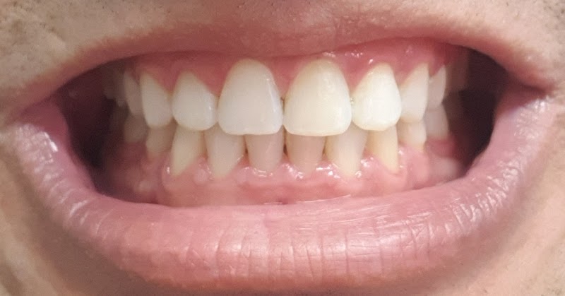 Priscilla Coelho - Dentista - Alinhador invisível - Invisalign - SouSmile - Clareamento - Recreio - foto 3