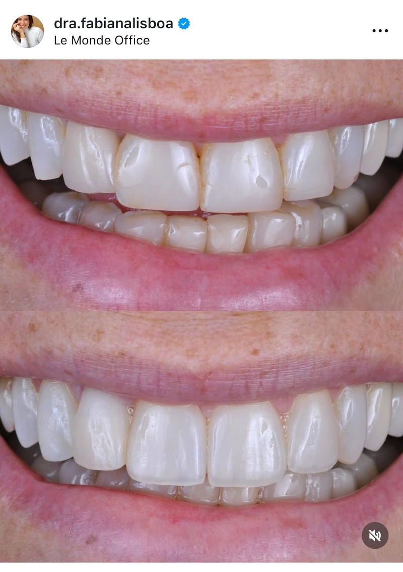 Dra. Fabiana Lisboa I Dentista I AirFlow I Limpeza sem Incômodo I Lentes de Contato I Periodontista I Implante - foto 5