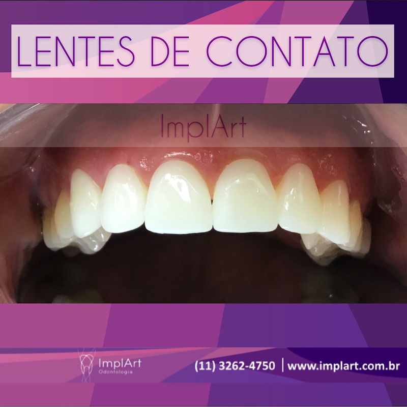 ImplArt Odontologia Implante Dentario