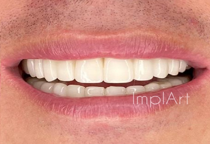 ImplArt Odontologia Implante Dentario - foto 2