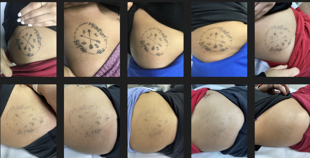 Shipers Laser Tattoo Removal Center Dallas tattoo work — photo 2