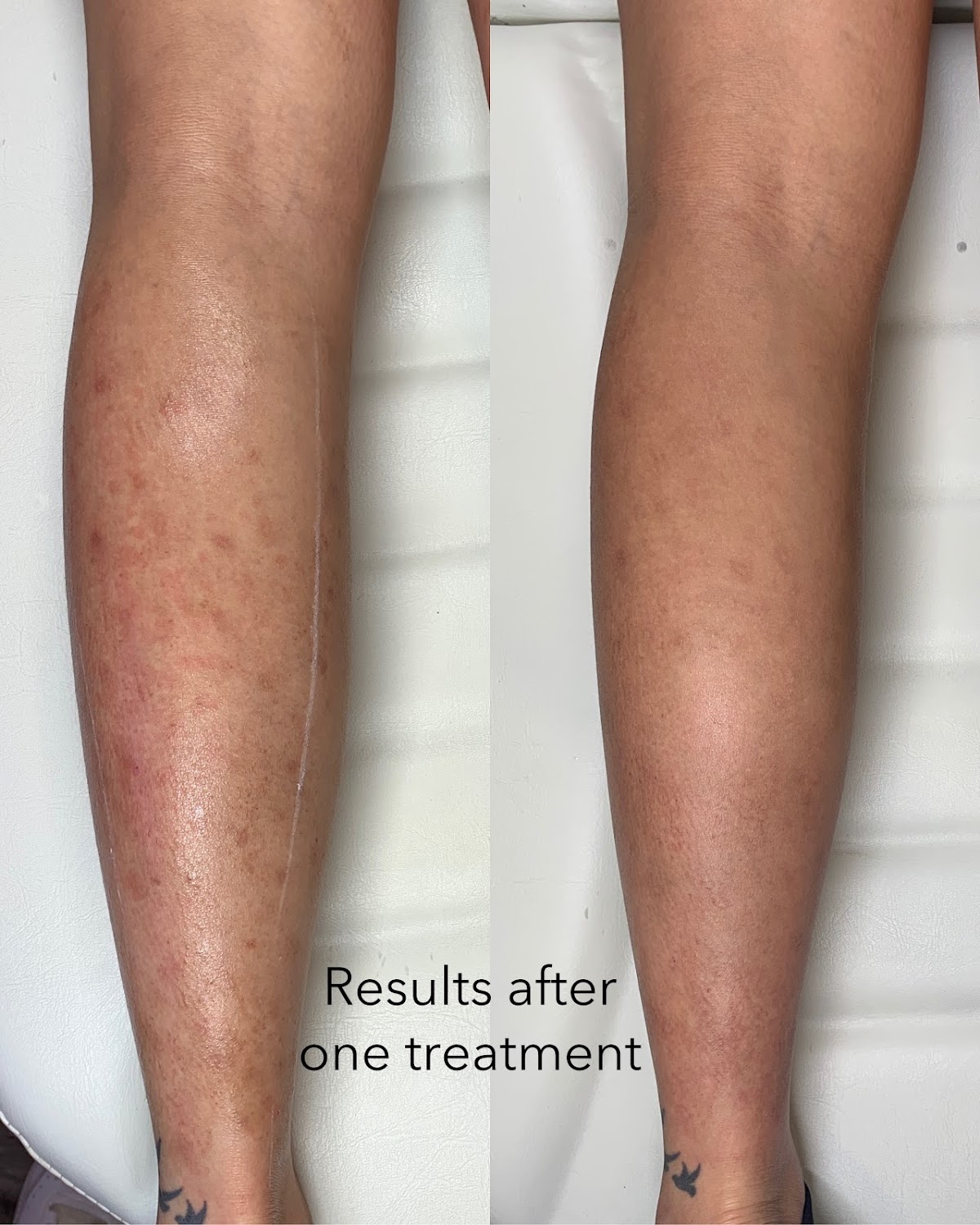 Austin Laser Solutions - Tattoo Removal INC tattoo work — photo 3