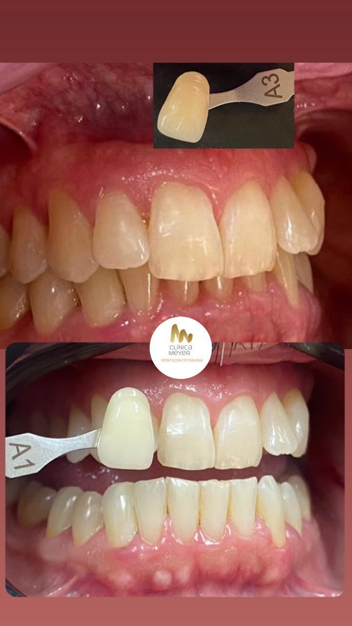 Clínica Meyer Odontologia Especializada/Estética em Resina/Salvador - foto 5