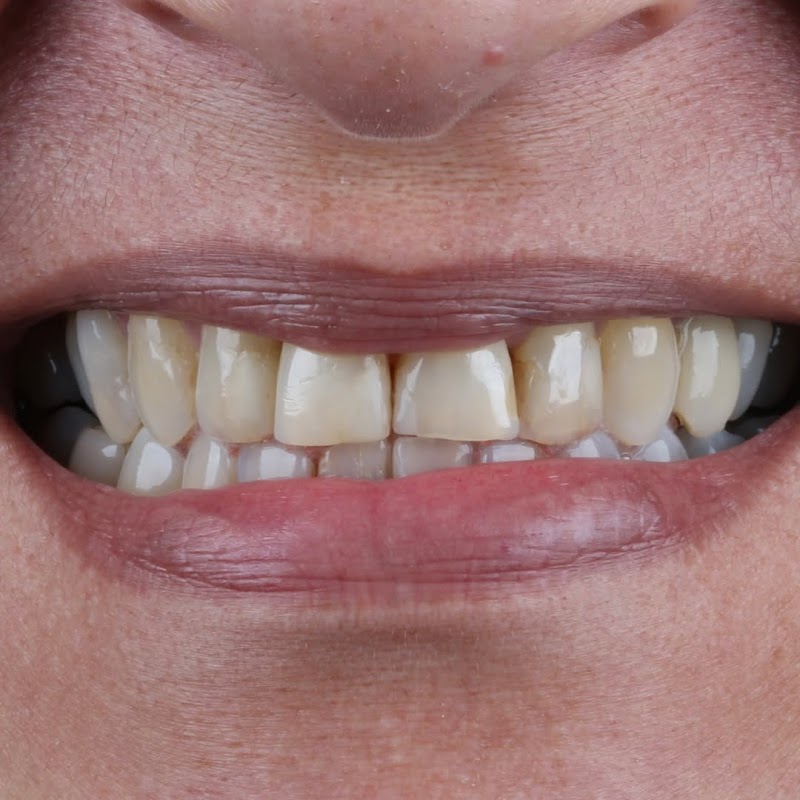 NP Clínica Odontológica | Dentista Asa Norte | Invisalign Lentes Resina Composta Asa Norte - foto 3