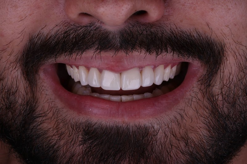 Lentes em Resina - Recreio dos Bandeirantes - Dra. Monique Oliveira