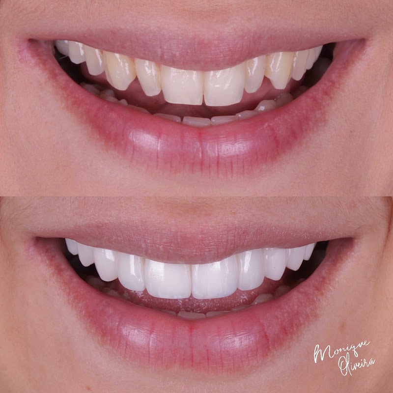 Lentes em Resina - Recreio dos Bandeirantes - Dra. Monique Oliveira - foto 2