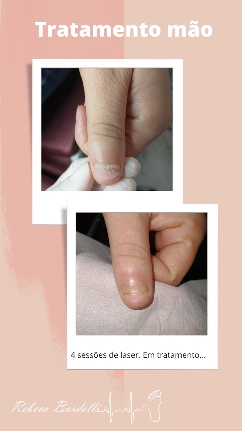 Foto de Rebeca Bardelli Podologia Clínica | Podologa | Unha encravada | Podologa Joinville | Tratamento de micose |