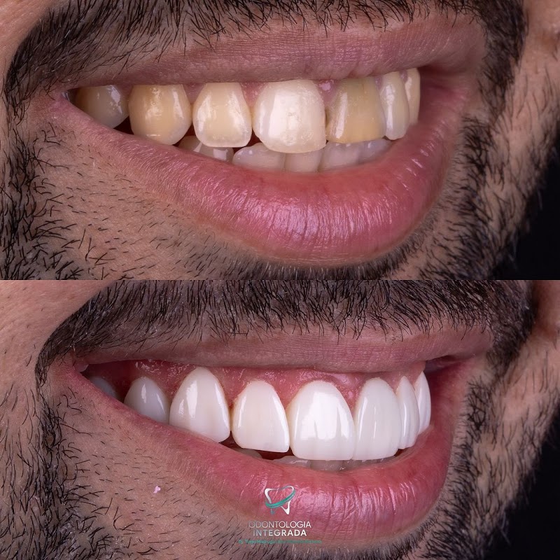 Odontologia Integrada Natal | Implante sem corte, sem dor e resultado imediato | Dentista em Natal/RN - foto 2