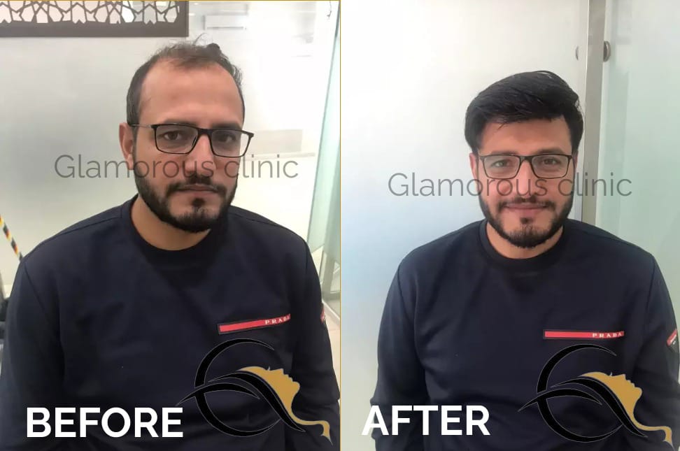 Glamorous Hair Transplant in Dubai | Glam Hair Clinic - FUE Hair Transplant Dubai, FUT Transplant, BioFibre, DHI 5