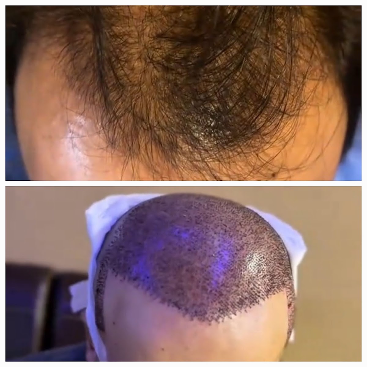 Glamorous Hair Transplant in Dubai | Glam Hair Clinic - FUE Hair Transplant Dubai, FUT Transplant, BioFibre, DHI